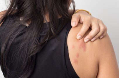 What Causes Hives?