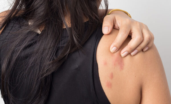 What Causes Hives?