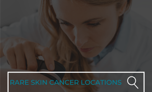 Rare Locations Skin Cancer Has Been Found