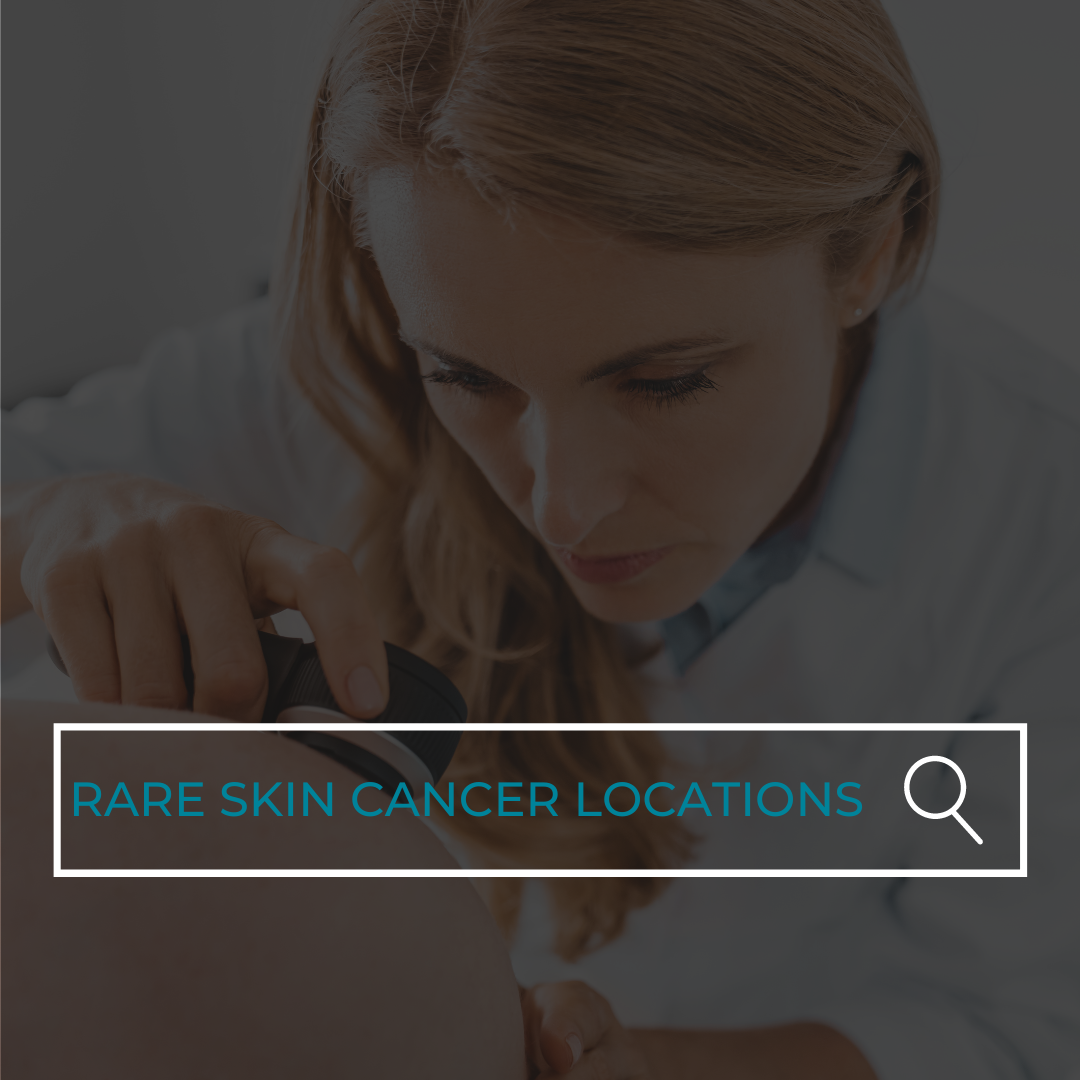 Rare Locations Skin Cancer Has Been Found