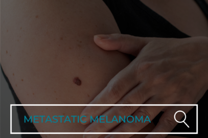 What is Metastatic Melanoma?