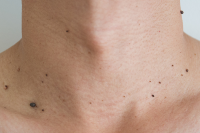 What Causes Skin Tags—and What You Can Do About Them