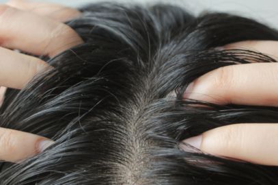 6 Common Causes of Itchy Scalp (and What to Do About Them)