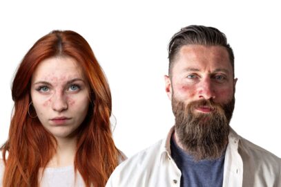 10 Rosacea Myths Busted by Certified Dermatologists