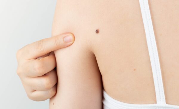 Does This Look Like Cancer? 4 Signs You Should Get Checked by a Dermatologist