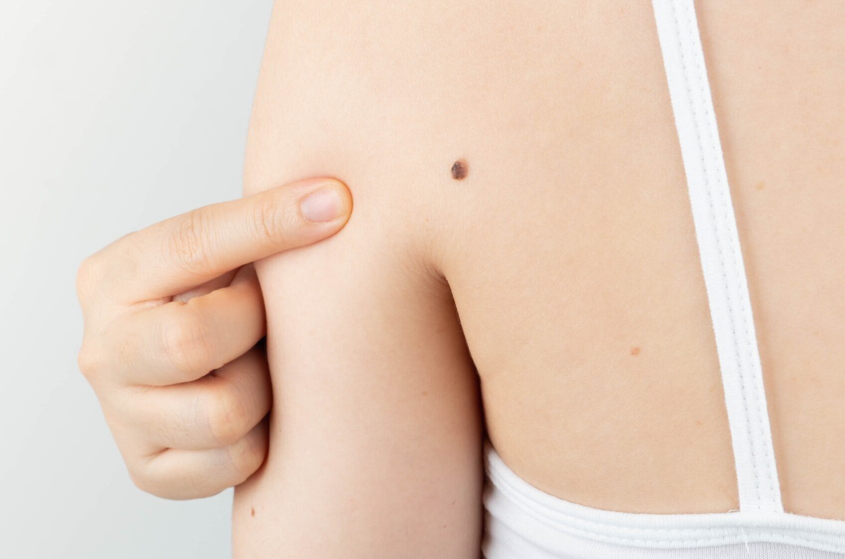 Does This Look Like Cancer? 4 Signs You Should Get Checked by a Dermatologist