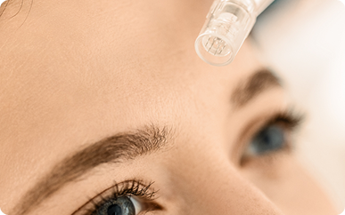 <strong>Microneedling</strong> for Smoother, Firmer Skin 