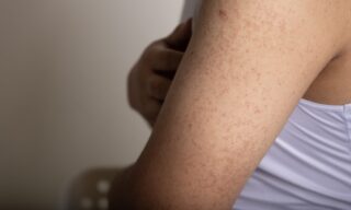 Why Fall Is The Best Time for Laser Treatments