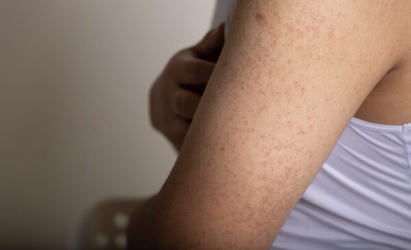 Keratosis Pilaris: The Bumps No One Talks About (But Everyone Googles)