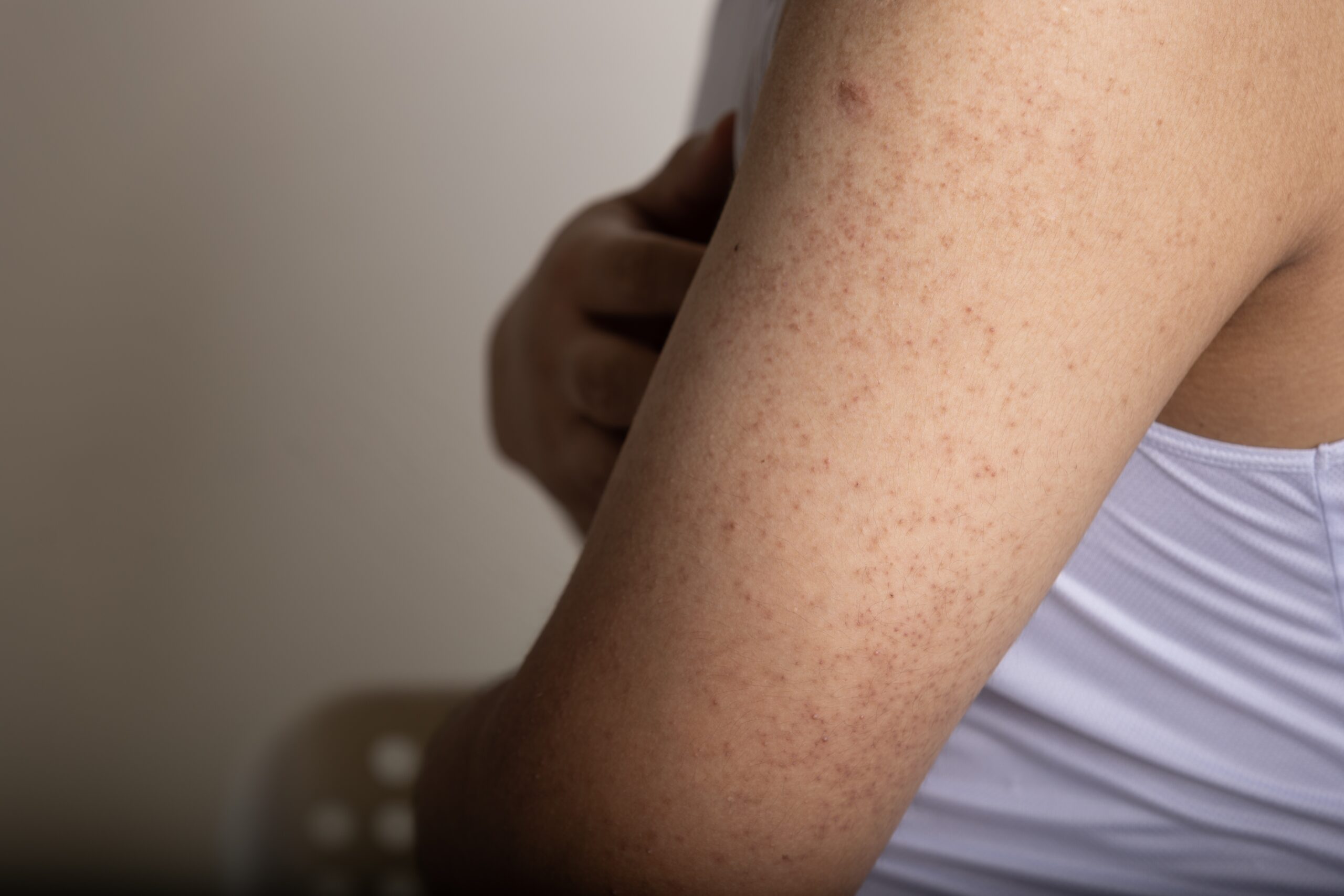 Keratosis Pilaris: The Bumps No One Talks About (But Everyone Googles)