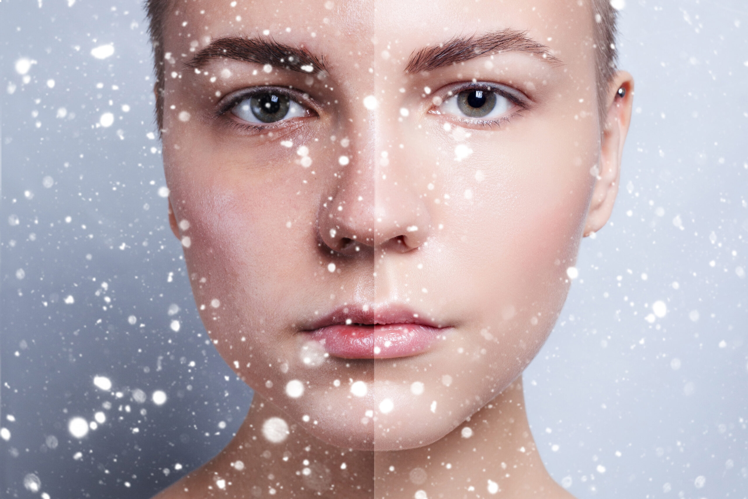 Why am I Breaking Out in Winter? The Cold-Weather Acne Mystery Explained