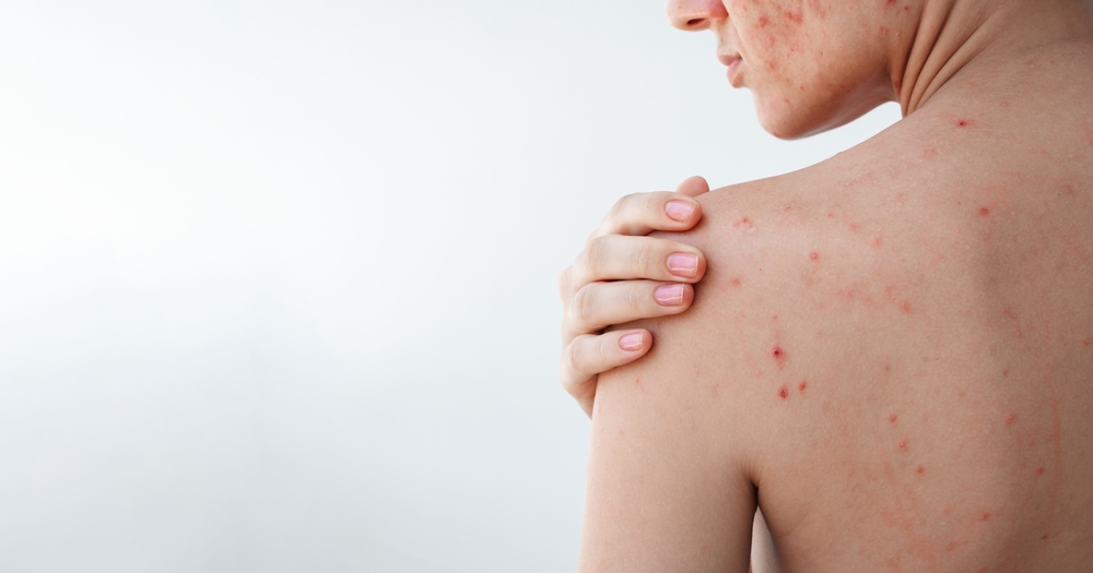 Breaking the Flare Cycle: How Modern Eczema Care Supports Your Skin’s Ecosystem